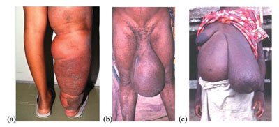 Lymphatic filariasis causing swelling and tissue damage
