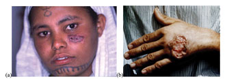 Ulceration due to cutaneous leishmaniasis