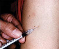 Intradermal injection of rabies cell-culture vaccine