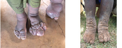 Podoconiosis is swelling and deformity of the feet and ankles