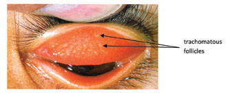Trachomatous follicles in the upper conjunctiva