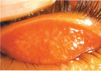 Trachomatous inflammation with trachomatous follicles