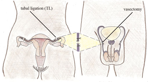 A diagram showing female and male sterilisation.