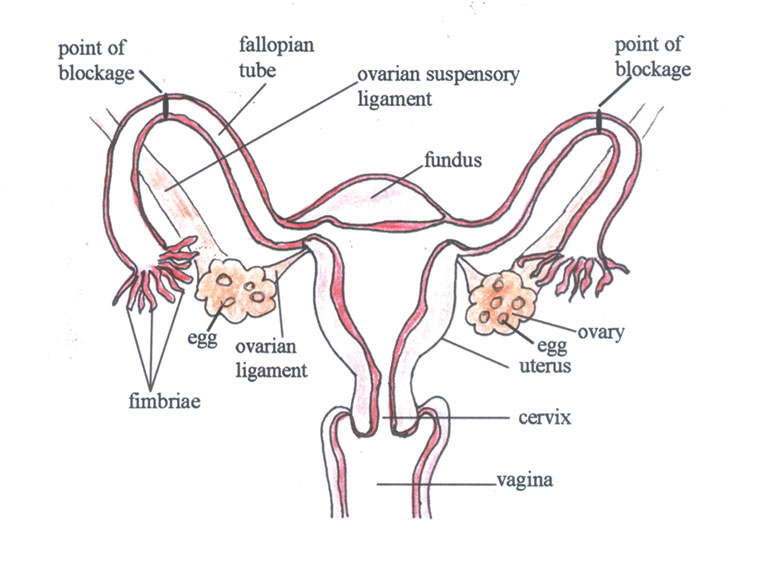 Tubal ligation.