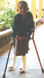 A young person with both legs in cast supporting himself on crutches.