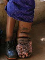 A woman with ‘mossy foot’ disease.