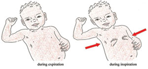 A sick child with signs of chest-in drawing represented by two pictures. One of expiration and the other of inspiration.