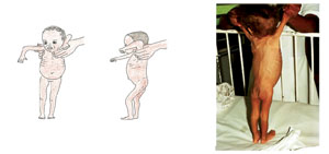 An infant with visible severe wasting.