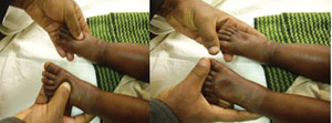 A photo showing a health worker checking for bilateral pitting oedema.