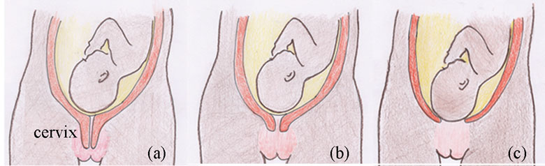 The three stages of effacement of the cervix.