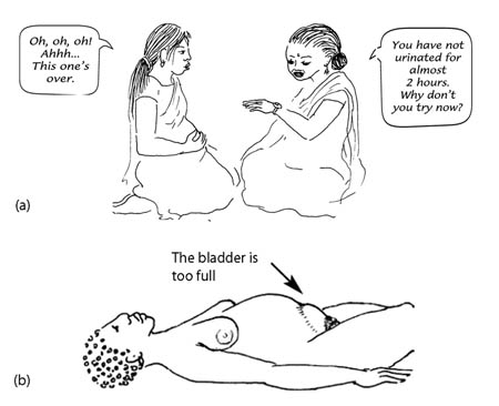 A health worker encourages the woman in labour to urinate frequently. Another woman lies down with a full bladder.