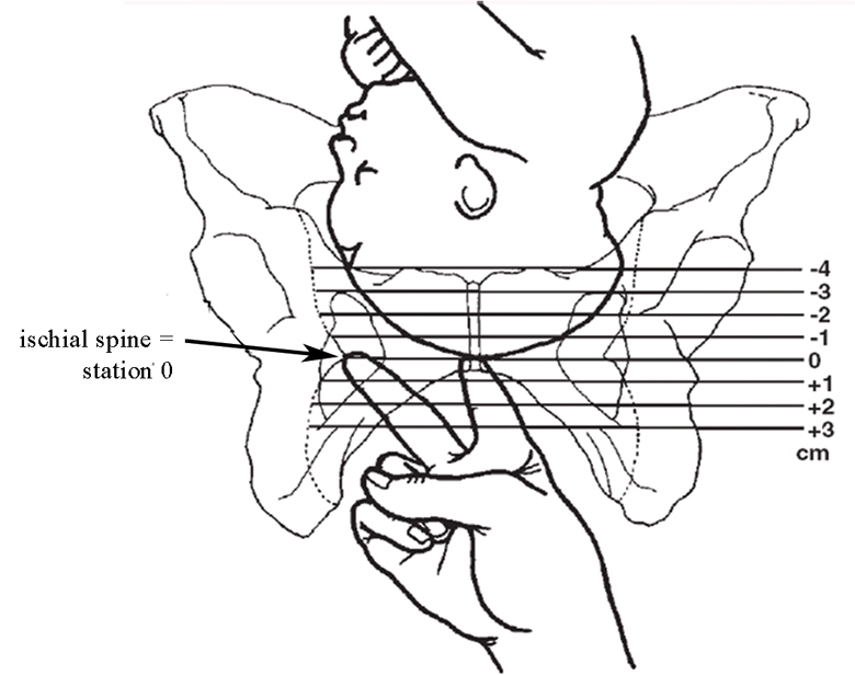 Assessing the station (descent) of the fetal head by vaginal examination, relative to the ischial spines in the mother’s pelvic brim.