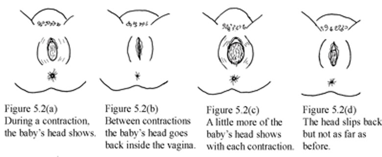 The baby head coming down the vagina during contractions.