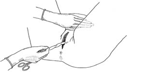 Controlled cord traction. The right hand is pulling the clamped umbilical cord (making traction) while the left hand is exerting counter-pressure on the lower abdomen, just above the pubic bone.
