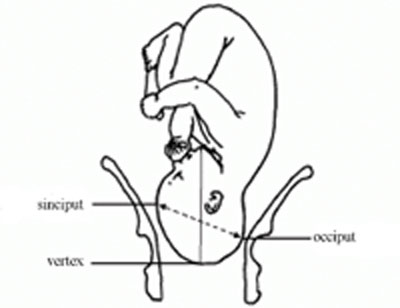 A baby in the well-flexed vertex presentation before birth, relative to the mother’s pelvis
