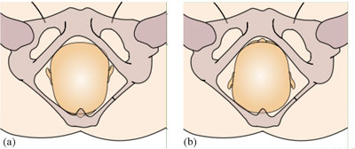 Possible positions of the fetal skull when the baby is in the vertex presentation and the mother is lying on her back: