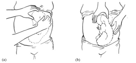 (a) The whole back of a baby in the vertex position will move if you rock it at the fundus; (b) The head can be ‘rocked’ and the back stays still in a breech presentation.