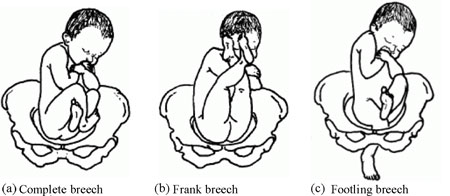 Figure 8.4  Different types of breech presentation.