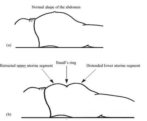 (a) Normal shape of pregnant abdomen during labour, in a woman lying on her back; (b) Bandl’s ring in the abdomen of a woman with obstructed labour.