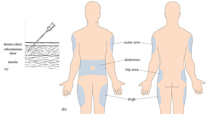 Diagram showing the penetration of a subcutaneous needle for injecting insulin. and preferable injection sites for insulin
