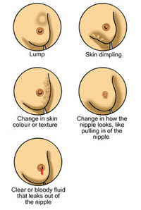 Drawings of changes in the breast