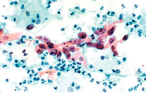 Pap smear of cells from the cervix