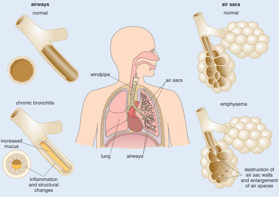 Normal and blocked airways and alveoli