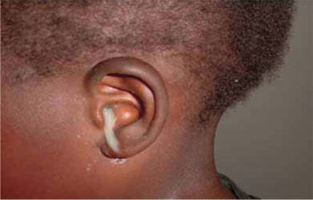 Pus discharge from ear infection