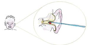 Foreign object being carefully removed