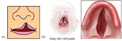 Diagrams of a cleft lip and palate