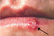 Cold sore caused by Herpes viruses