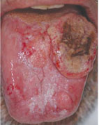 Cancer and infection of the tongue