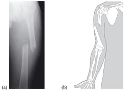X ray and diagram of bone fractures