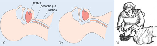 Diagram of a person’s airway