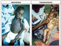 Children with Marasmus and Kwashiorkor