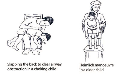 Resuscitation method to overcome choking in children