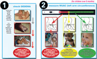 How to identify acute malnutrition in a child