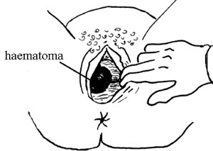 A haematoma can be seen through the opened vagina.