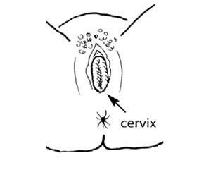 The prolapsed cervix can be seen at the opening of the vagina.