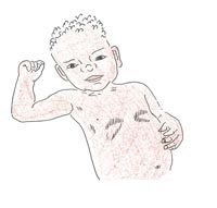 A newborn with chest in-drawing.