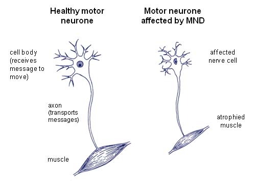 Healthy motor neurone and muscles, and affected motor neurone with wasted muscle